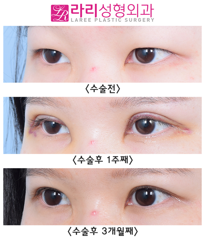 [Lari Plastic Surgery] The Recovery Process After Incisional Ptosis Correction: Don’t Be Surprised, Just Wait! image 2