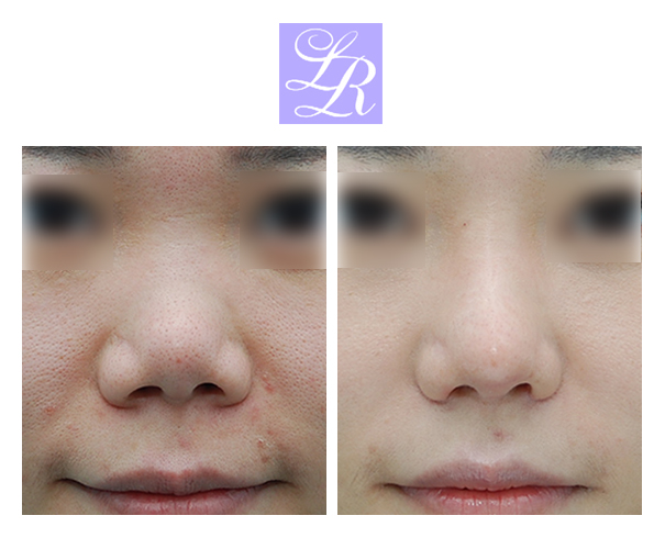 Revision Rhinoplasty Using Rib Cartilage (Autologous Rib Cartilage vs. Donor Rib Cartilage) image 1