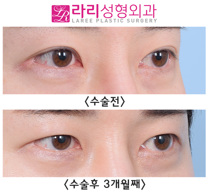 [Lari Plastic Surgery] Surgery to Remove Double Eyelids: Can It Really Make Double Eyelids Disappear? "YES!" image 3