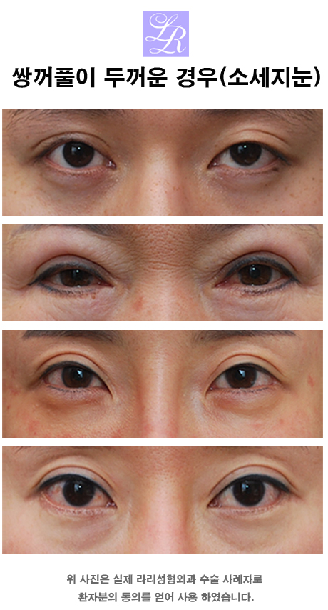 About the Appropriate Height of Double-Eyelid Lines image 4