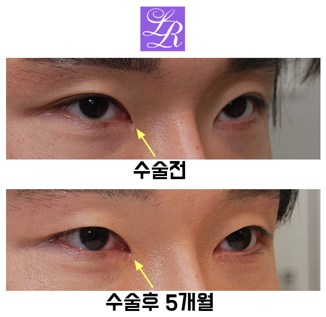 Review of Double Eyelid Removal Surgery + Epicanthic Fold Hook Removal Inner Corner Surgery image 5