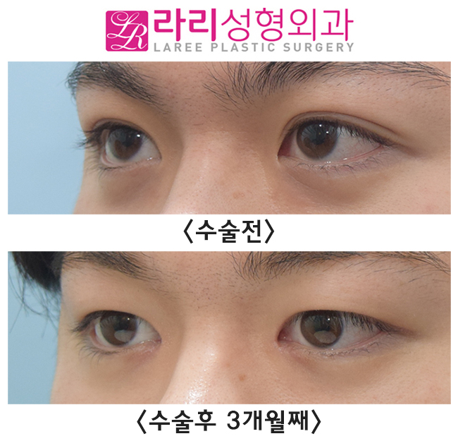 [라리성형외과] 남자다워지고 싶은 예쁜 자연 쌍꺼풀, 무쌍 만들기 관련 이미지 4