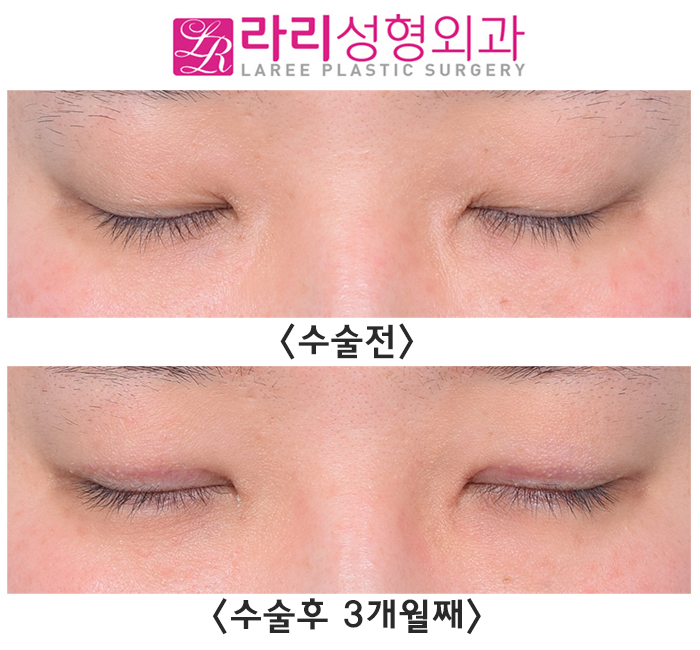 [Lari Plastic Surgery] Before and After Incisional Ptosis Correction Surgery for a Soft Impression Without Feeling Overdone image 4