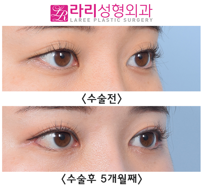[Rari Plastic Surgery] First Eye Surgery (Non-incisional eyelid correction, epicanthoplasty, canthoplasty) Before-and-After Photos image 3