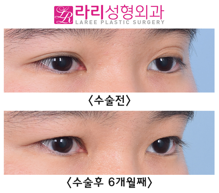 [Lari Plastic Surgery] Correcting a Severe Uneven Eye with Double Eyelid Removal Surgery image 2