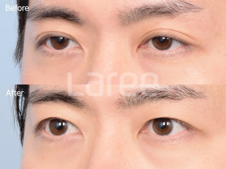 [Lari Plastic Surgery] Everything About Double Eyelid Removal Surgery image 7