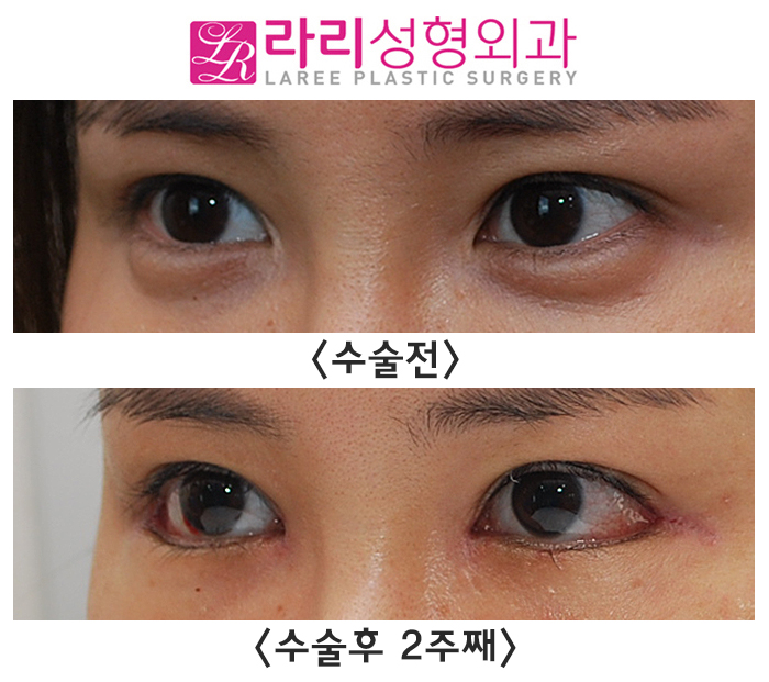 [Rari Plastic Surgery] Medial Canthoplasty Reoperation, Lateral Canthoplasty: Short-Term Progress on the Day of Stitch Removal Before and After Surgery image 2