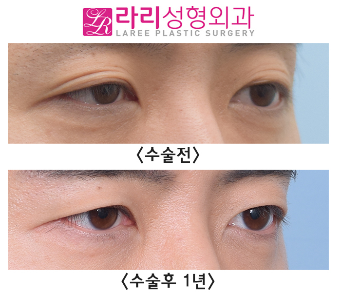 [Rari Plastic Surgery] Natural Double Eyelid Multiple Folds, Removing Them to Create a Monolid: Before and After Surgery After 1 Year image 2