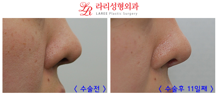 코재수술 잘하는곳 변화가 확실한 라리성형외과! 관련 이미지 7