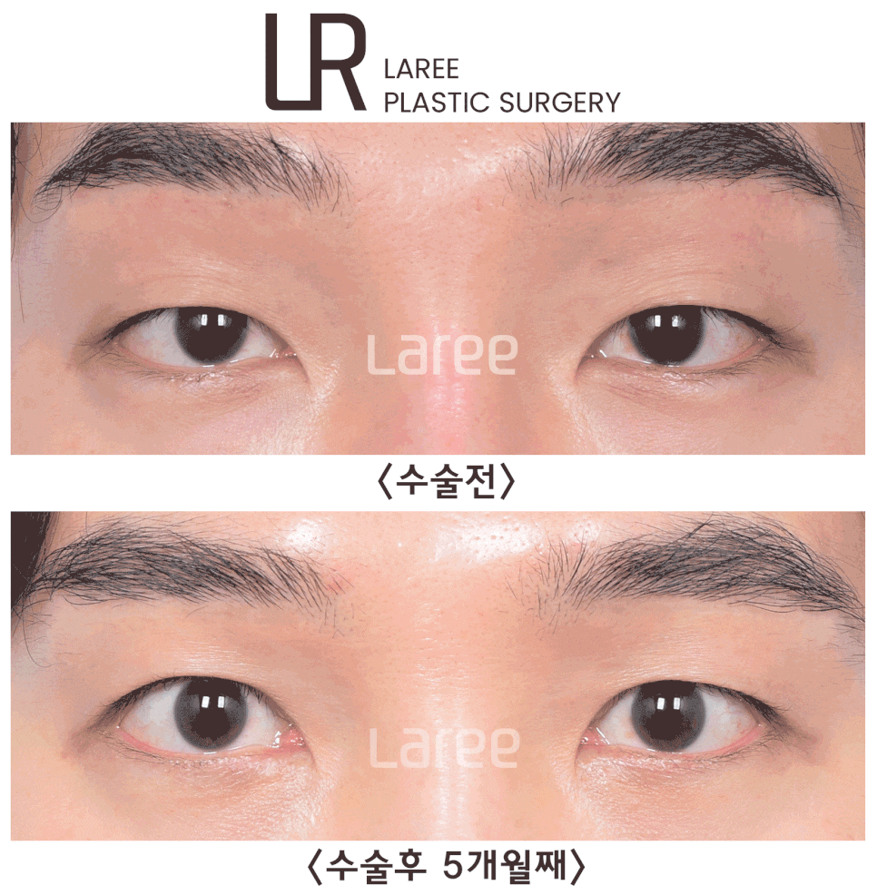 [Lari Plastic Surgery] The Real Way to Make Eyes Bigger: Eyelid Correction Surgery Is Needed Before Canthoplasty. image 4