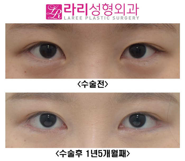[라리성형외과] 눈이 확실히 커지는 눈 성형수술 3종 세트 (쌍수, 앞트임, 뒤트임) 관련 이미지 1