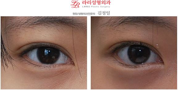 Lower Canthoplasty, Lower Under-Eye Canthoplasty, Bobby Lower Canthoplasty Before and After Photos image 1
