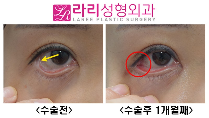 [라리성형외과] 뒤트임재수술,결막이식으로 뒤트임부작용(물갈퀴변형, web deformity) 교정하기 관련 이미지 3
