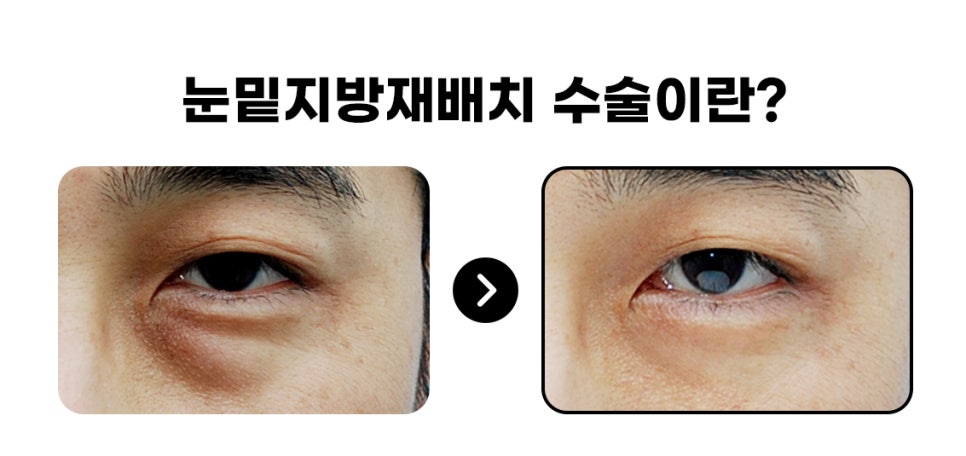 [라리성형외과] 하안검성형 VS 눈밑지방재배치(제거) : 어떤 수술을 해야 할까? 관련 이미지 2