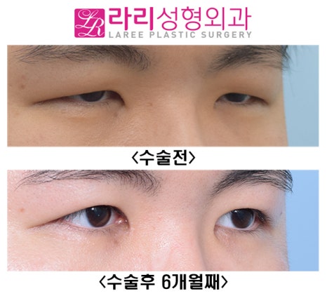 [Lari Plastic Surgery] The Effect of Double Eyelid Incision Ptosis Correction That Opens Unopened Eyes Wide image 4