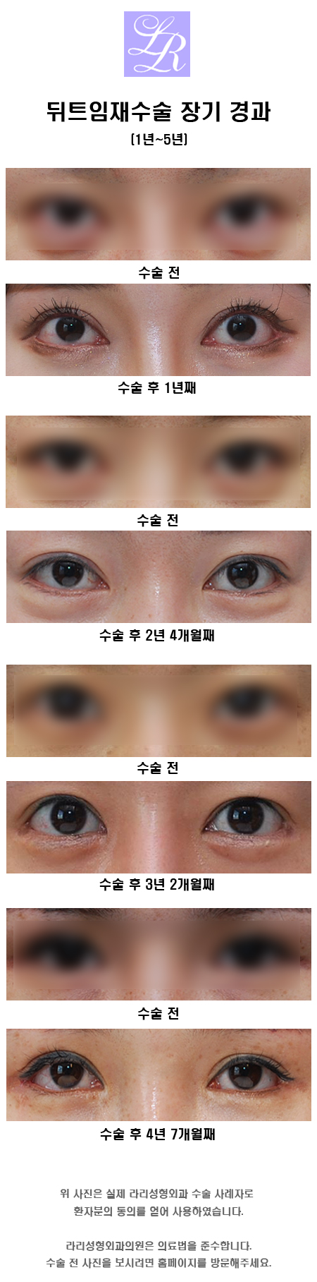 Revision Lateral Canthoplasty: Short-Term, Mid-Term, and Long-Term Progress (feat. Lari) image 4