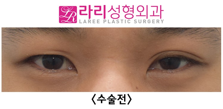 [Lari Plastic Surgery] See the Process of Correcting Uneven Eyes After Double Eyelid Removal Surgery image 1
