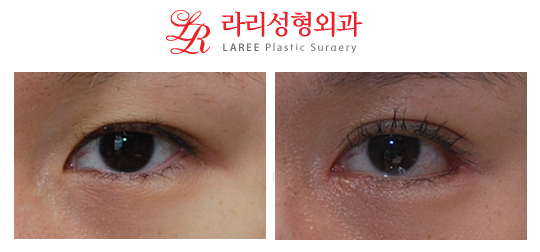 쌍꺼풀매몰재수술 앞트임 눈꼬리내리기뒷트임/뒤트임 전후사진☆ 관련 이미지 1