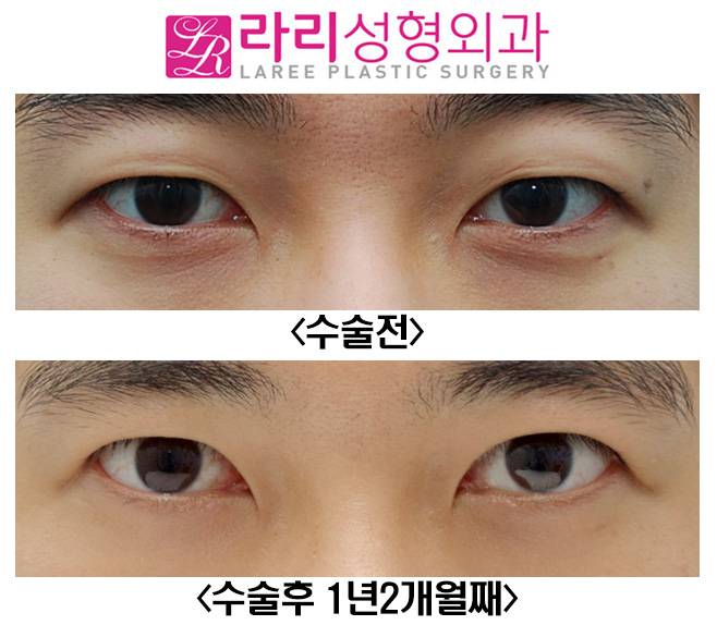 [Lari Plastic Surgery] Full Non-Incision Eye Correction, Effects and Before-and-After Photos (Different from Double Eyelid Surgery) image 6