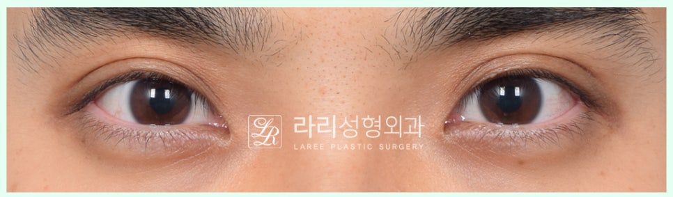 [Lari Plastic Surgery] Removing a Visible Double Eyelid (Double Eyelid Reversal Surgery), From Natural Double Eyelids to Surgical Double Eyelids: A to Z image 2
