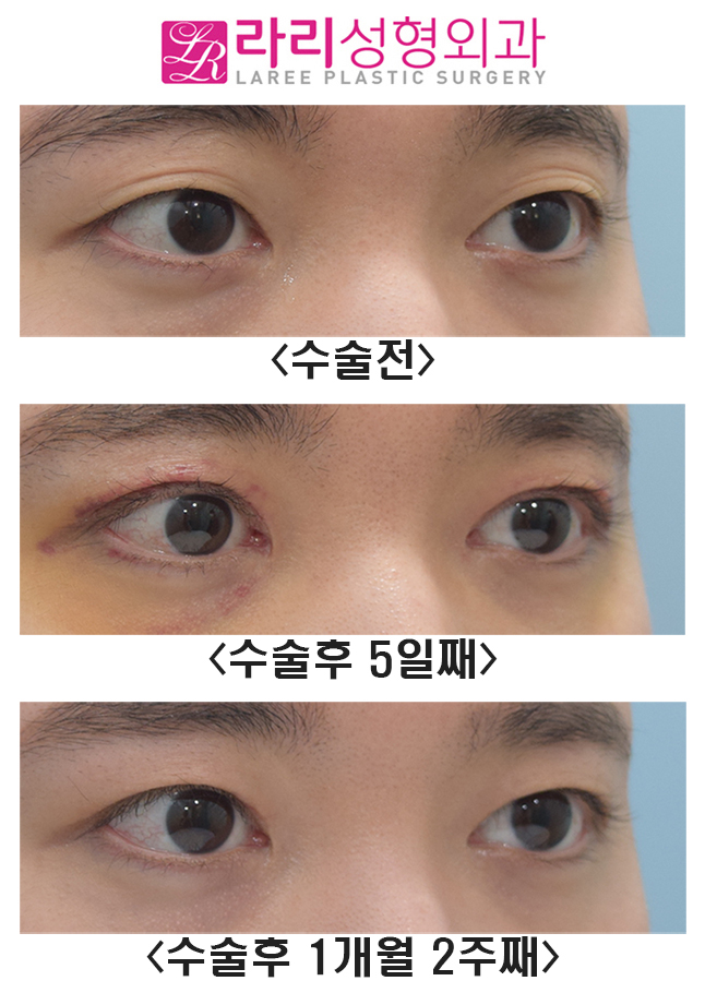 [라리성형외과] 여러겹 쌍꺼풀라인 없애기 관련 이미지 5