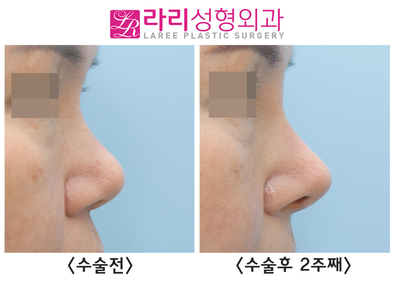 [라리성형외과] 코재수술, 입툭튀를 개선하는 고양이수술 효과 전후 사진 관련 이미지 2