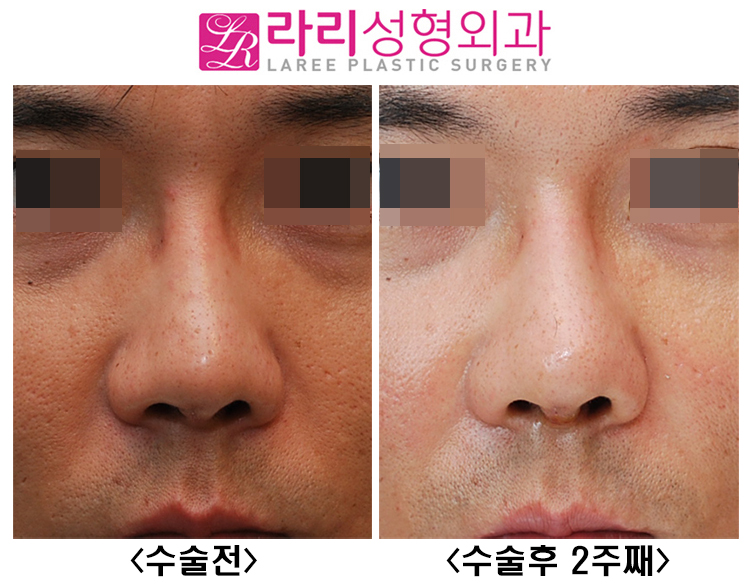 [라리성형외과] 코재수술 : 미용 목적만이 아닌 경우, 복원과 재건 관련 이미지 1