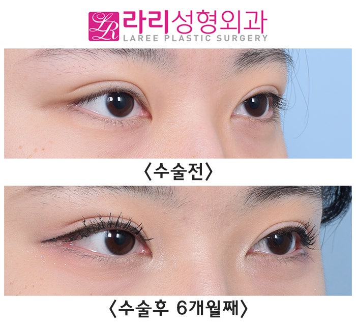 [라리성형외과] 6개월 차 자연스럽지만 티나는 눈꼬리내리기뒤트임 수술 전후 사진 관련 이미지 2