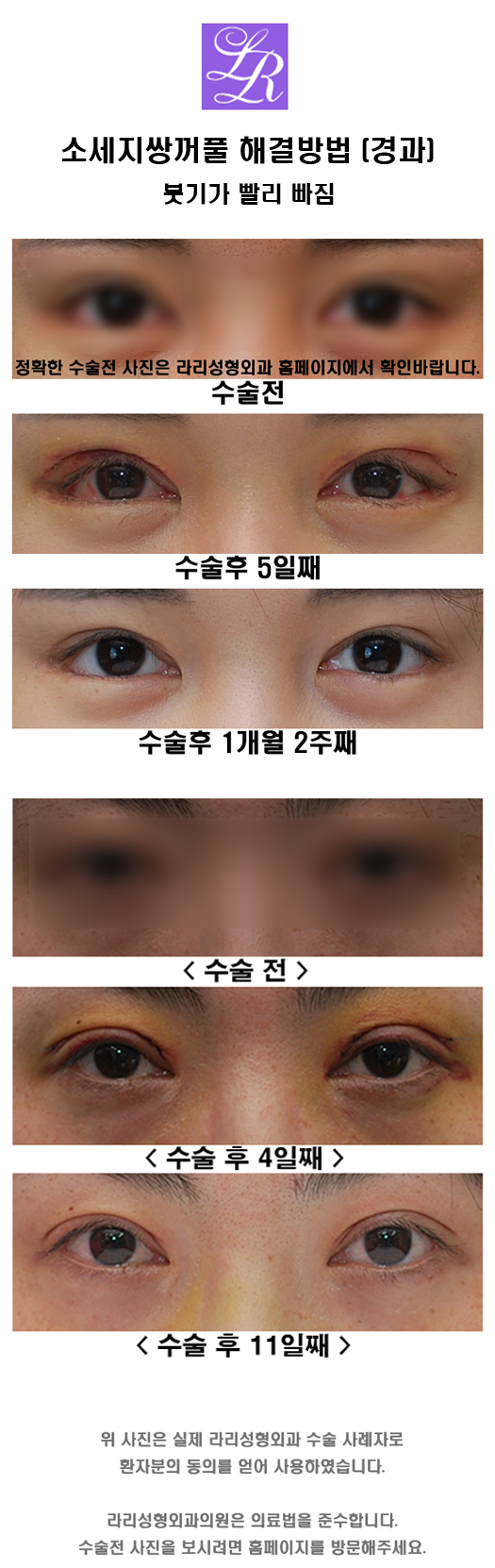 What Is the Way to Fix “Sausage Eyes” and “Sausage Double Eyelids”? image 5