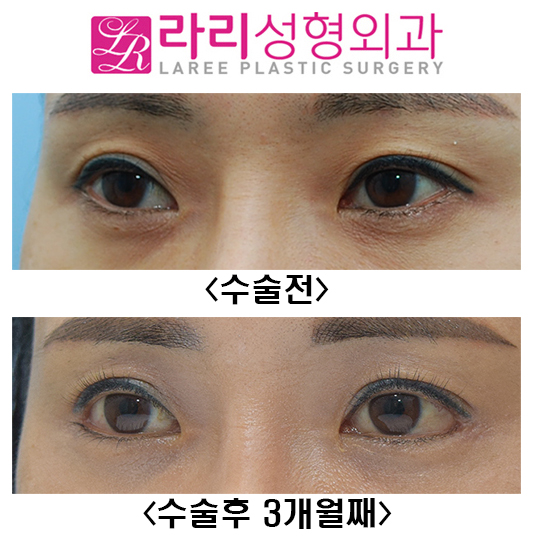 [Lari Plastic Surgery] Before-and-After Photos 3 Months After First Canthoplasty image 3
