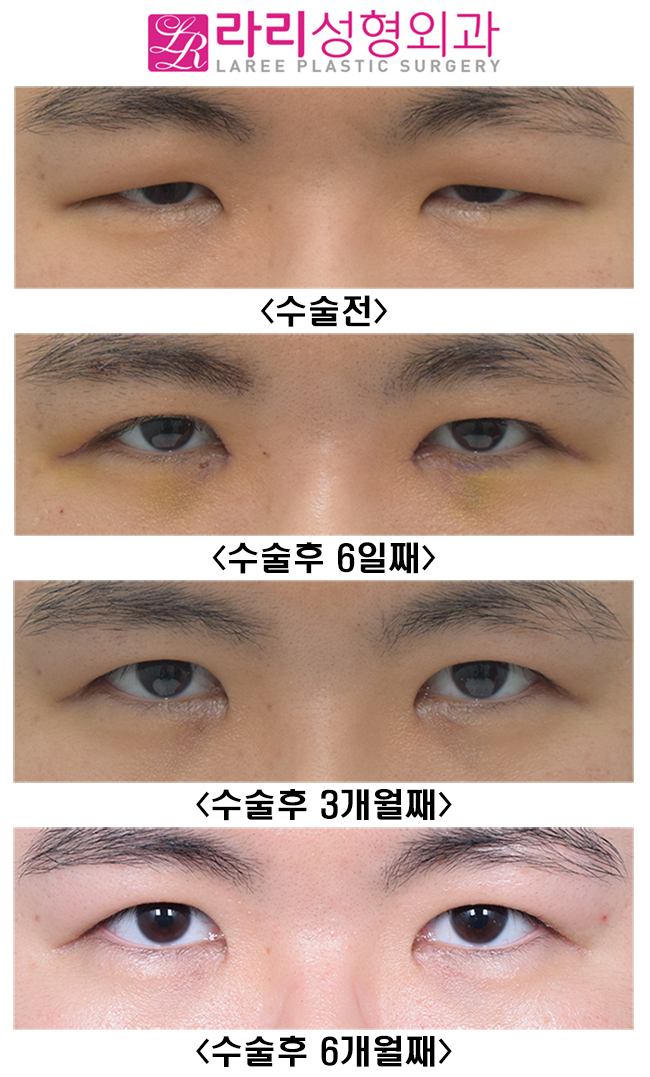 [Lari Plastic Surgery] The Effect of Double Eyelid Incision Ptosis Correction That Opens Unopened Eyes Wide image 2