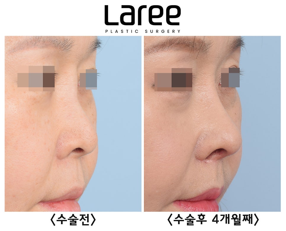 [라리성형외과] 고양이수술과 인중축소수술을 병행한 자가늑 코재수술(+콧대영구필러제거) 관련 이미지 2