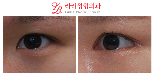 ☆Wangnuni Plastic Surgery☆ Before-and-after photos of epicanthoplasty and lateral canthoplasty with lowering of the outer eye corner: long-term follow-up of over 2 years! image 2