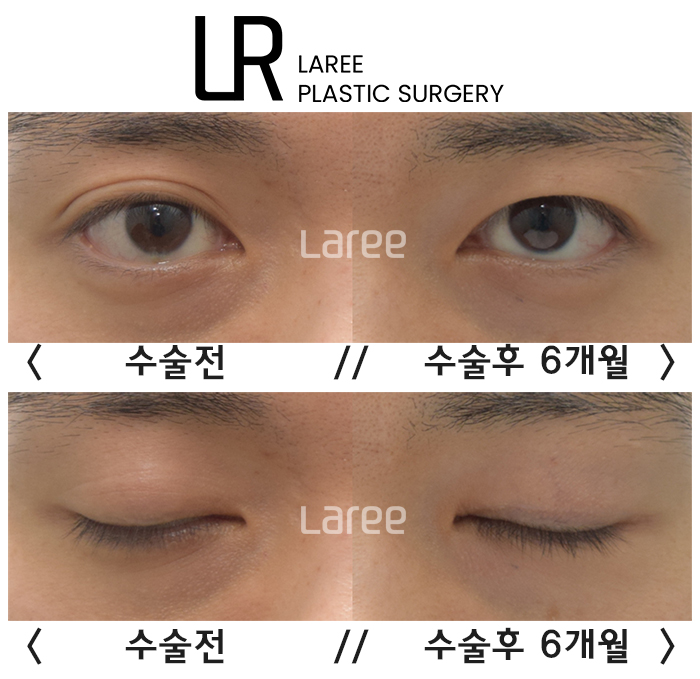 [라리성형외과] 쌍꺼풀수술은 괜찮은데 쌍꺼풀없애는수술은 괜찮지 않다고 ? 관련 이미지 4