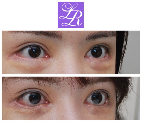 Long-Term Follow-Up Review Confirming the Effect of Lower Canthoplasty image 9