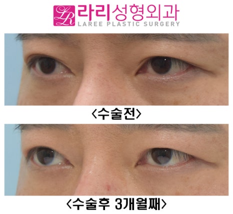 [Lari Plastic Surgery] Surgery to remove double eyelids only removes the double eyelids. image 6