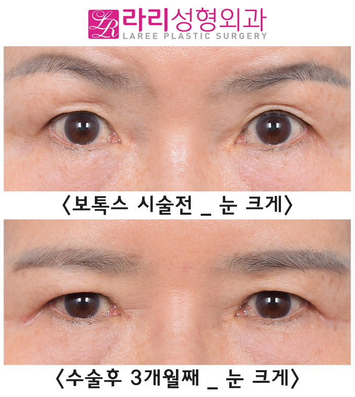 [Rari Plastic Surgery] Why You Should Get Forehead Botox Before Upper Blepharoplasty, as Seen in Before-and-After Photos image 5