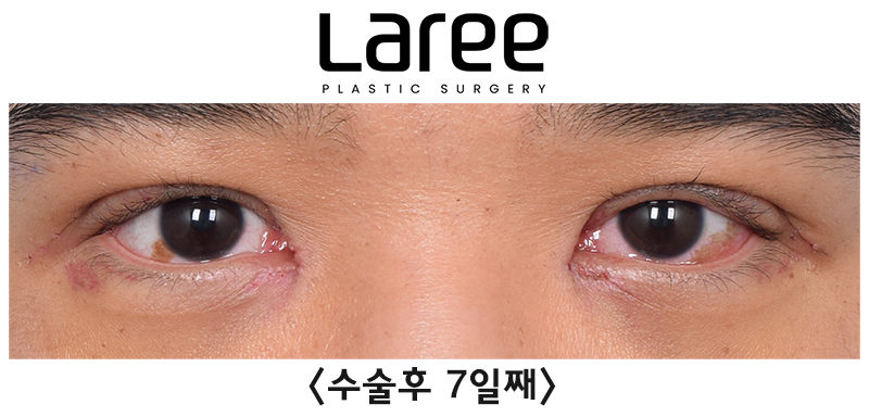[Lari Plastic Surgery] Eyelid Correction Surgery and Upper Canthoplasty: Experiencing the Maximum Effect of Non-Double-Eyelid Eyelid Correction Without Medial Drooping image 3