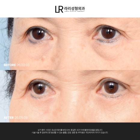 [라리성형외과] 눈 밑이 피곤해 보이는데 눈 밑에 지방만 빼면 될까?(눈밑지방재배치수술 VS 하안검수술) 관련 이미지 5