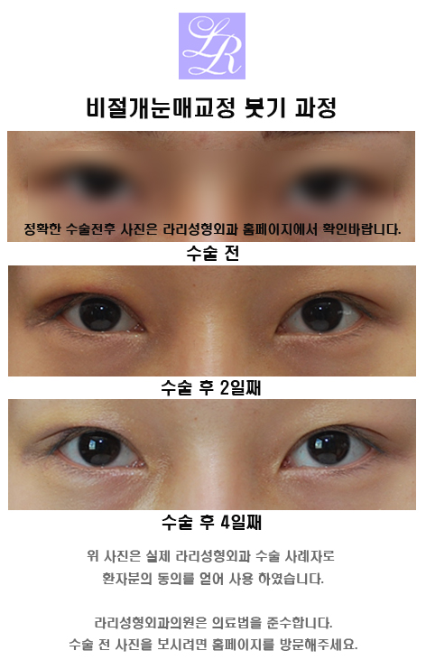 Why Does Non-Incisional Ptosis Correction Come Undone in Monolid Ptosis? image 2