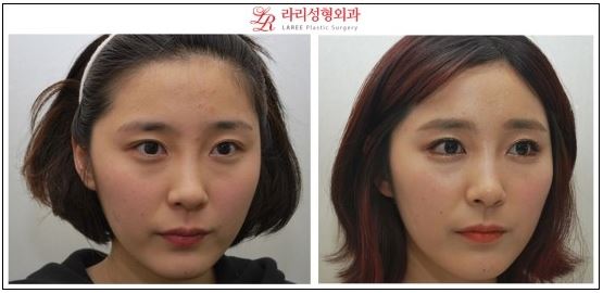 Lateral Canthoplasty / Outer Corner Canthoplasty / Outer Eye Corner Lowering Canthoplasty Before and After Photos image 3
