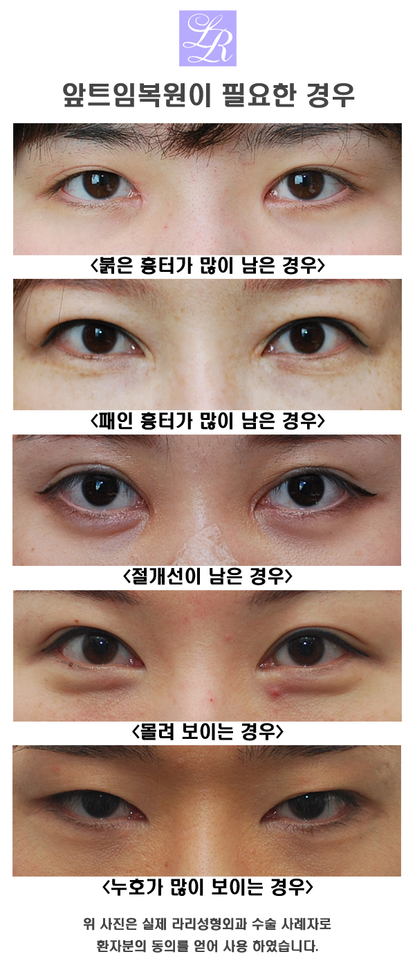 몽고주름없애는 앞트임후기 관련 이미지 1