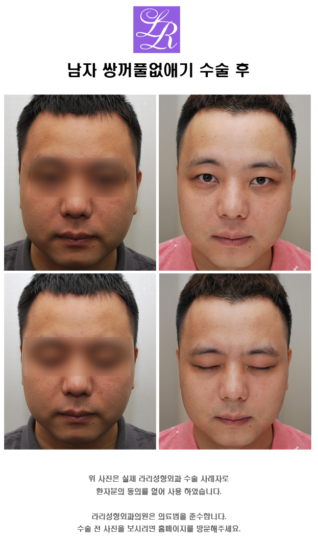 What Should You Check Before and After Male Eye Shape Correction? image 6