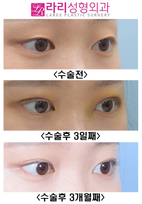 [라리성형외과] 흉터 없이 말끔한 매몰 쌍수 어때요? 관련 이미지 3