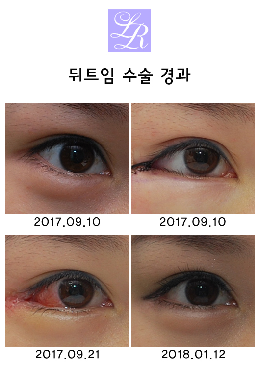 뒷트임 단기 경과 (feat. 라리성형외과) 관련 이미지 5