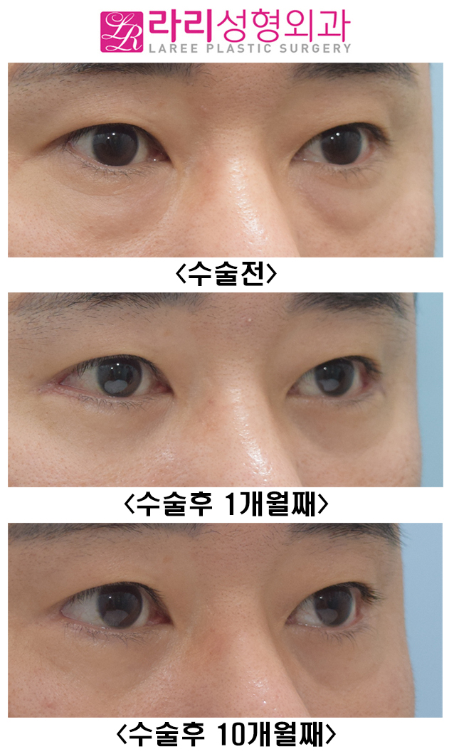 [라리성형외과] 남자 눈꼬리내리기 뒤트임수술 후 변화 관련 이미지 3