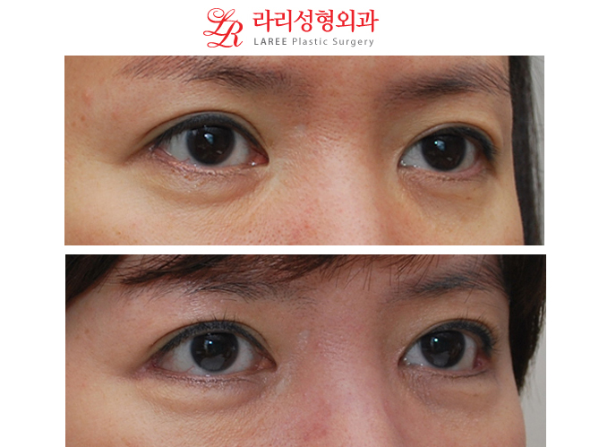 앞트임재수술,눈꼬리가 많이 올라가지 않은 경우의 눈꼬리내리기뒤트임재수술 관련 이미지 2