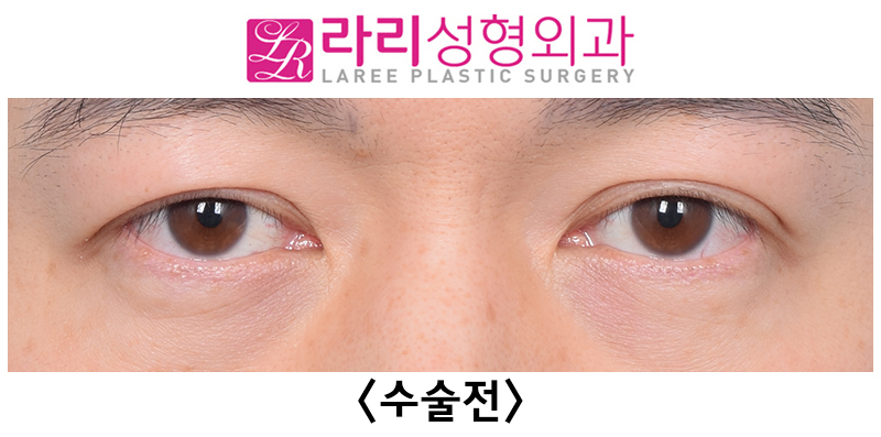 [라리성형외과] 쌍꺼풀없애기 수술 눈안감김(토안)의 원인이 정말 피부절제 때문일까? - 무절제쌍꺼풀없애기 관련 이미지 7