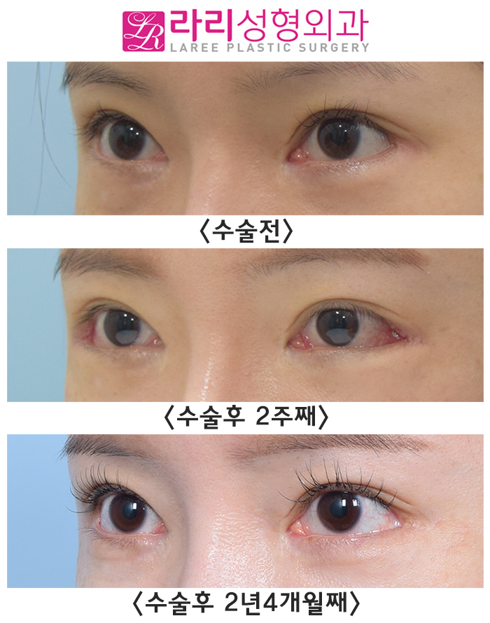 [라리성형외과] 뒷트임수술(재수술, 재재수술) 회복 기간 중이라면 걱정하지 말자 관련 이미지 3