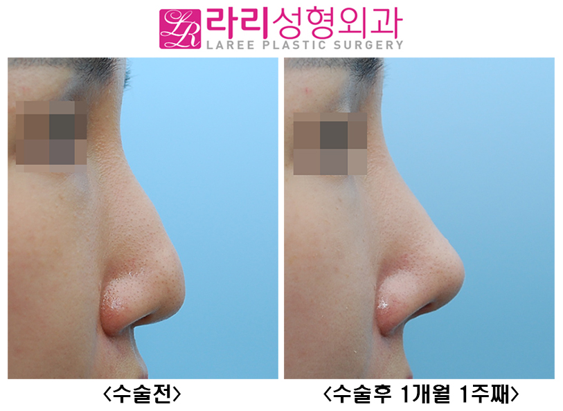 [Rari Plastic Surgery] Nose Bridge and Tip Surgery After Hyco Removal image 3